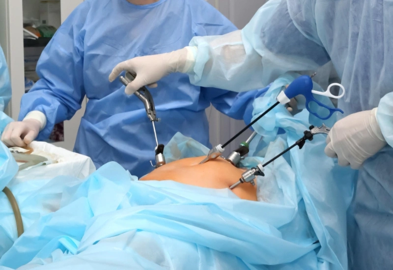 Laparoscopic Hysterectomy